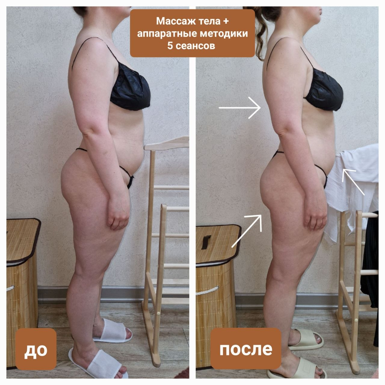 До и после массажа тела с аппаратными методиками, 5 сеансов